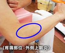 テニス肘(外側上顆炎)