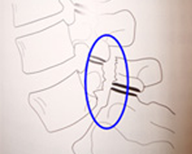 腰椎分離症