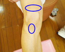 ジャンパー膝（膝蓋靭帯炎）